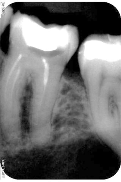 Reprise avec perforation qfn4u0 - Eugenol