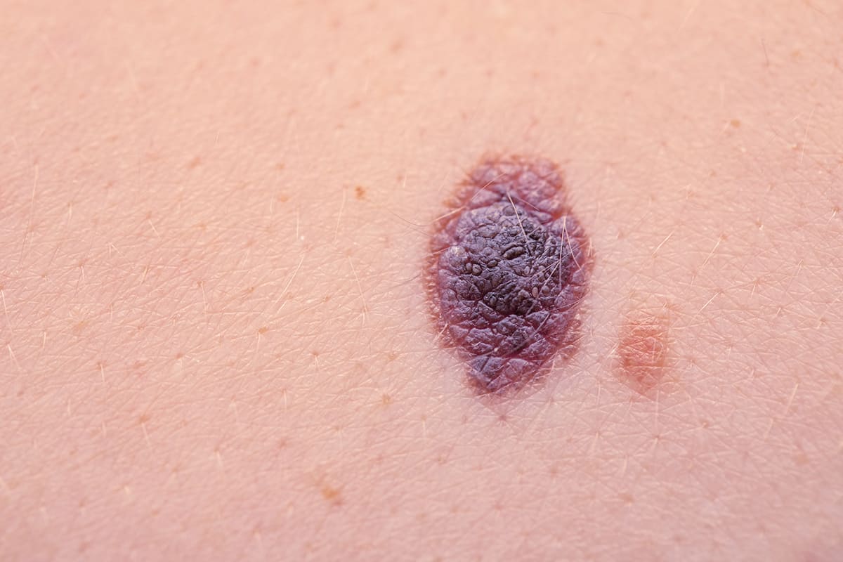 Settlement following fatal delayed melanoma diagnosis at United