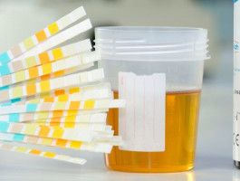 eine Hand hält mehrere Teststreifen an eine Urinprobe.