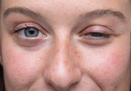 Nahaufnahme eines Gesichts, das eine Person mit einem offenen und einem halb geschlossenen Auge zeigt. Die Haut weist Sommersprossen und eine leichte Rötung auf.