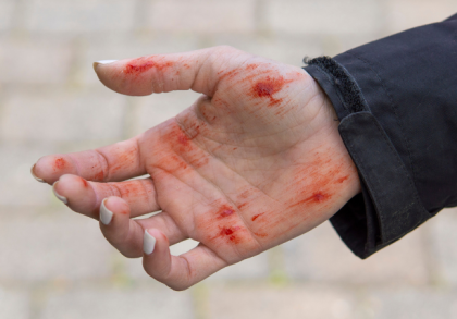 Offene Hand mit blutigen Schürfwunden nach einem Sturz, Nahaufnahme vor gepflastertem Hintergrund – Symbolbild für Erste Hilfe bei Hautverletzungen.