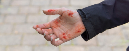 Offene Hand mit blutigen Schürfwunden nach einem Sturz, Nahaufnahme vor gepflastertem Hintergrund – Symbolbild für Erste Hilfe bei Hautverletzungen.