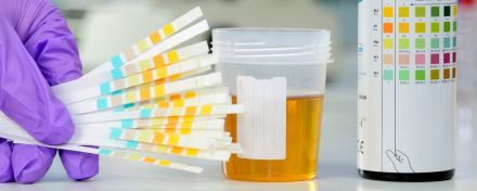 eine Hand hält mehrere Teststreifen an eine Urinprobe.