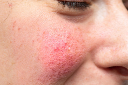 Frau mit sichtbarer Gesichtsrötung durch Rosacea an Wangen und Nase