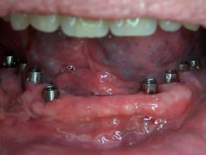 01positdental  003 c7vzaz - Eugenol