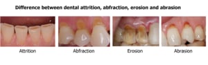 071115061241attritionabfractionerosionabrasion qxylml - Eugenol