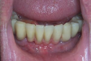 11 04 11 positdental 021 o3wsrz - Eugenol