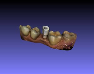 17031304 cas implantaire rizzo   mandibule scan body iy32wa - Eugenol