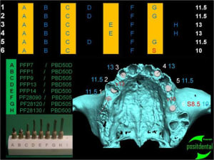 1 extraction mci bridge provisoire avec armature m tal eynugb - Eugenol