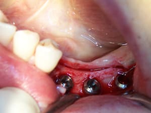 2010.04.positdental - Eugenol