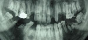 26 ans toutes ses dents    vm3qdc - Eugenol