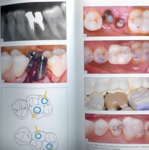 2 implants pour 16 h3ingm - Eugenol
