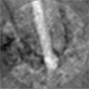 35 dévitalisation a bdxzje - Eugenol