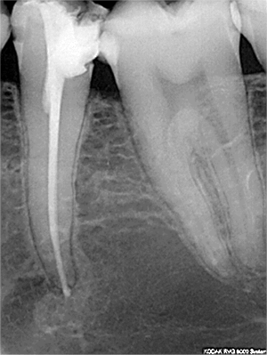 35 dévitalisation oyxnhv - Eugenol