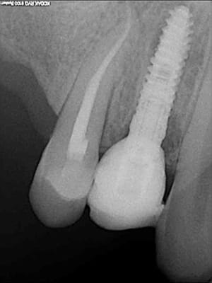4 implant et couronne provisoire qiko4e - Eugenol