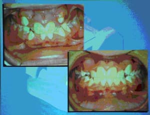 Bouche 1 ijyv5m - Eugenol