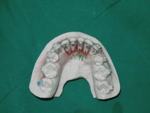 Bracket on model2 scsb1r - Eugenol