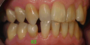 Dent83 42ans cra2co - Eugenol