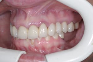 Edavant blaznl - Eugenol