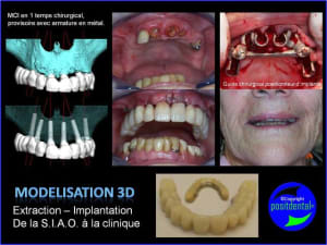 Extraction implantation mod lisation 3d positdental 9 wewcw8 - Eugenol