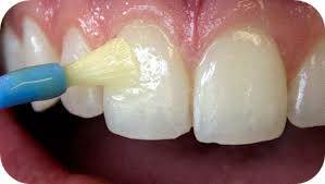 Gc mi varnish 1 kbj9ch - Eugenol