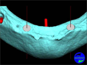 Guide chirurgical 006 cpe9vz - Eugenol
