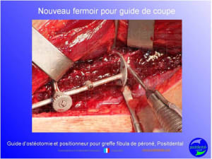 Guide d ost otomie  positionneur fibula positdental002 rliwj6 - Eugenol
