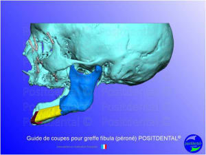 Guide de coupes pour greffe fibula  p ron   positdental 011 frltdu - Eugenol