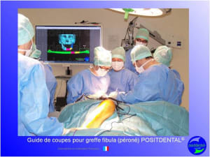 Guide de coupes pour greffe fibula  p ron   positdental 013 h9svlt - Eugenol