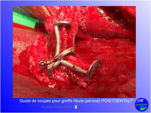 Guide de coupes pour greffe fibula  p ron   positdental 019 da8h8b - Eugenol