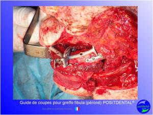 Guide de coupes pour greffe fibula  p ron   positdental 030 emijrc - Eugenol