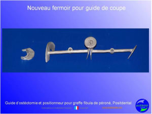 Guide de coupes pour greffe fibula  p ron    positdental 034 qadw2o - Eugenol