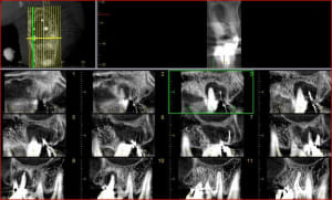 Guillaumin   mondelange   implants 2 u1mwiz - Eugenol
