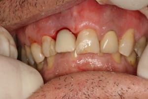 Implant 11 009 ssbkyt - Eugenol