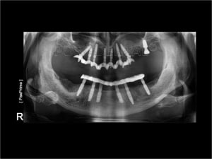 Implant dentsply ankylos et mci 002 ra6mam - Eugenol
