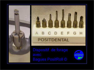 Implant tbr z1 et mci 002 xloiam - Eugenol