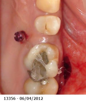 Ingression molaire1 jymoib - Eugenol