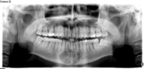 Kyste mand ea1mxb - Eugenol