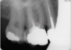 Lb fracture xjenvp - Eugenol