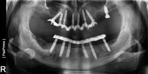 Mci bimaxillaire t2jax1 - Eugenol