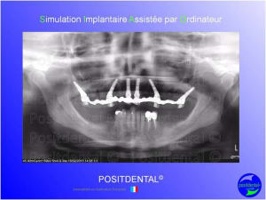 Mci  mise en charge imm diate  chirurgie implantaire guid e 003 oepj0d - Eugenol