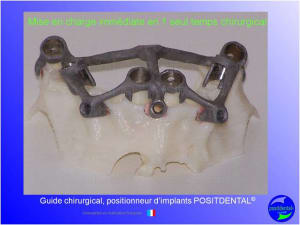 Mci  mise en charge imm diate  chirurgie implantaire guid e 008 j5zlr3 - Eugenol