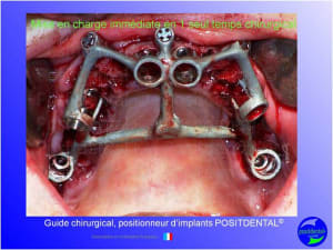 Mci  mise en charge imm diate  chirurgie implantaire guid e 009 mihw3r - Eugenol
