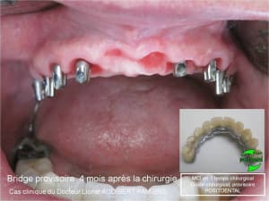 Mci en 1 temps chirurgical 2 d0ypyh - Eugenol