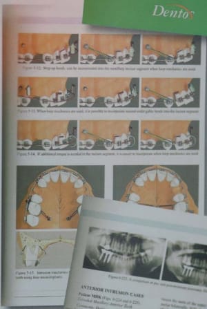Mini implants du0bdl - Eugenol