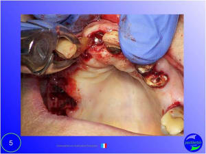 Mise en chage imm diate 005 d9v85h - Eugenol