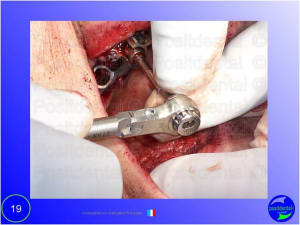 Mise en chage imm diate 020 su3ejq - Eugenol