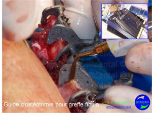 Mise en chage imm diate 121 z4hlno - Eugenol