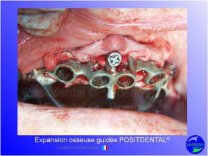 Mise en chage imm diate 154 kkbvbc - Eugenol