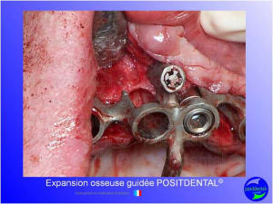 Mise en chage imm diate 157 xflxv0 - Eugenol